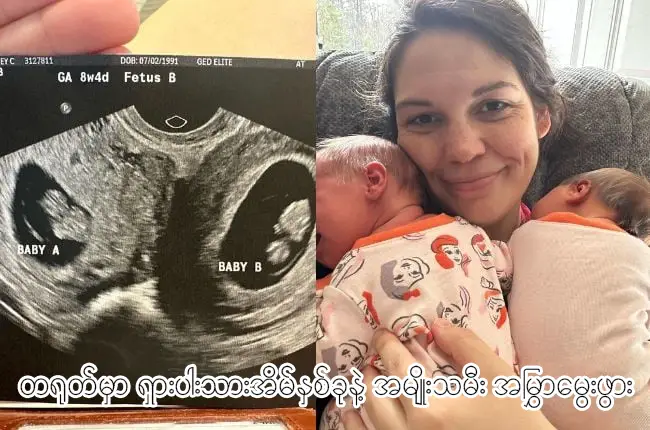 တရုတ်မှာ ရှားပါးသားအိမ်နှစ်ခုနဲ့ အမျိုးသမီး အမြွှာမွေးဖွား xda77.net